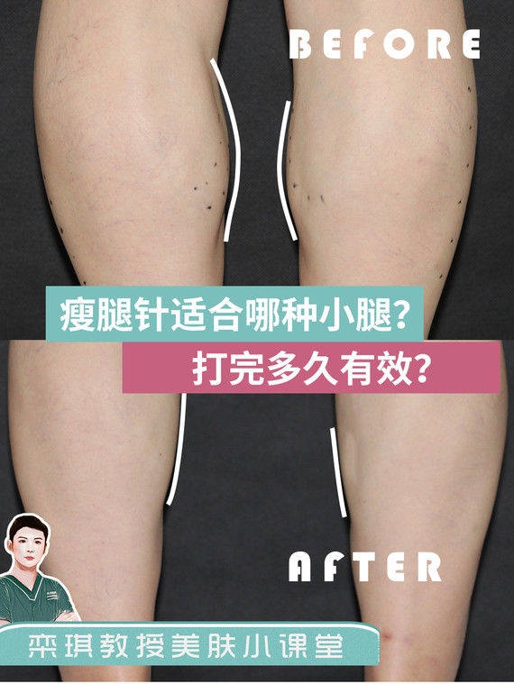 注射瘦腿针作用明显吗_注射瘦腿针明显么_瘦腿针注射